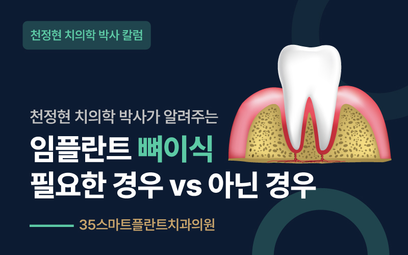 임플란트 뼈이식, 꼭 해야 하는 경우와 아닌 경우 - 천안치과 원장 칼럼